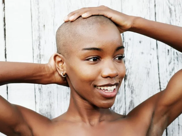 Alopecia is No Laughing Matter for Millions of Black American Women