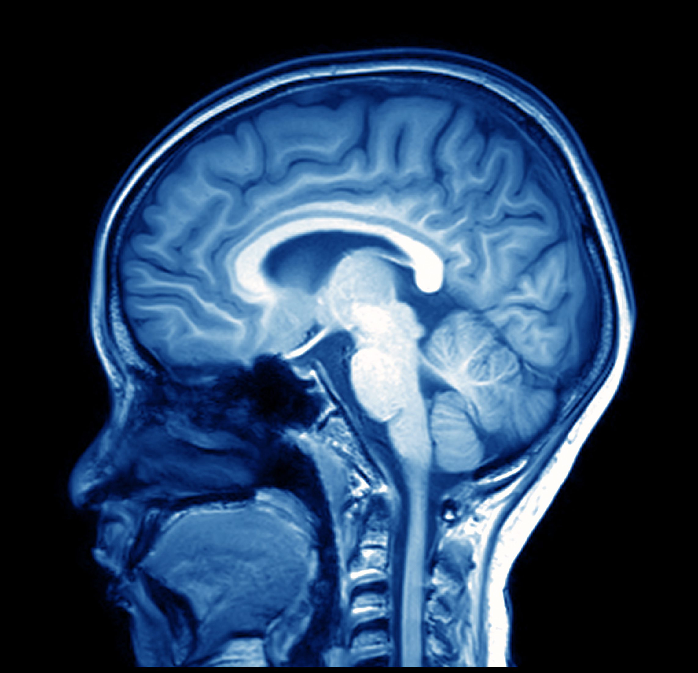 Even Mild Cases of COVID-19 Can Leave a Mark on the Brain