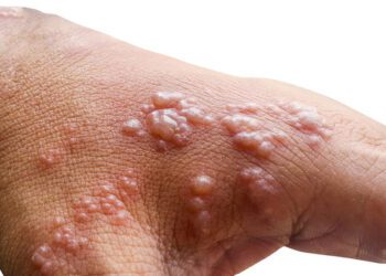 How Does Monkeypox Spread?