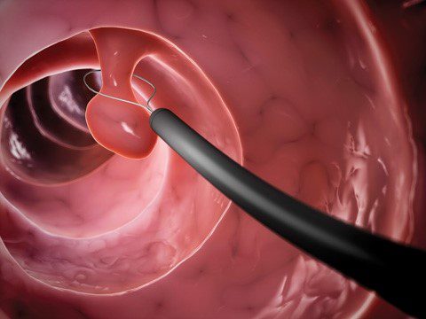 The Value of a Colonoscopy