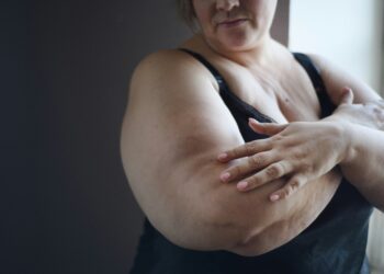 Obesity is More Than a Number