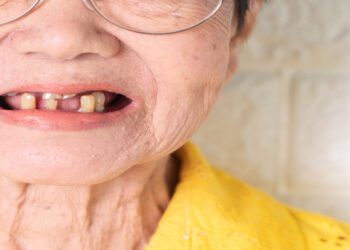 An older woman wearing glasses and a yellow shirt has her mouth open. She has several broken and missing teeth.