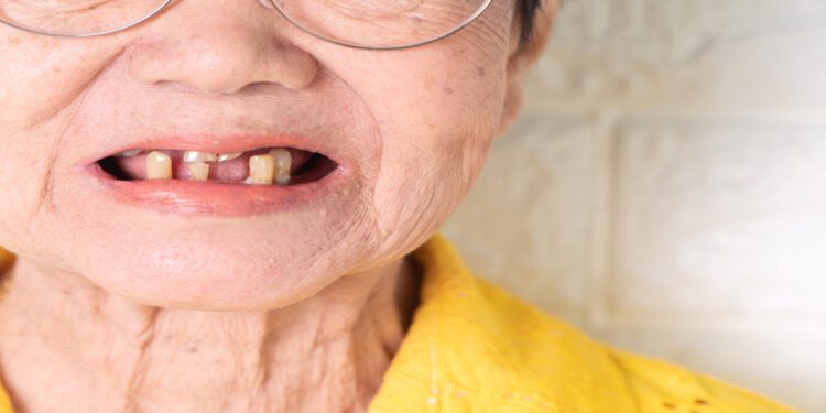 An older woman wearing glasses and a yellow shirt has her mouth open. She has several broken and missing teeth.